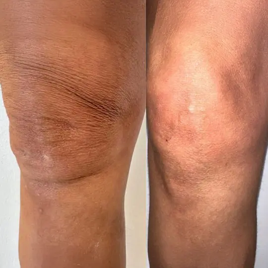 Vorher Nachher RF- und Microneedling