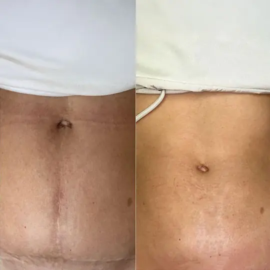 Vorher Nachher RF- und Microneedling Porenbild Essen